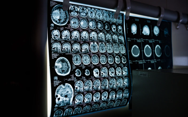 Chụp MRI có thể được chỉ định để chẩn đoán rò dịch não tủy