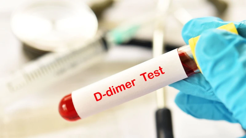 Nồng độ D-dimer tăng cho thấy quá trình hình thành và phân hủy fibrin đang gia tăng