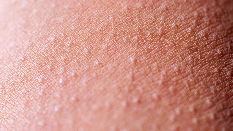 Rôm sảy gây nổi chấm đỏ li ti trong thời tiết nóng