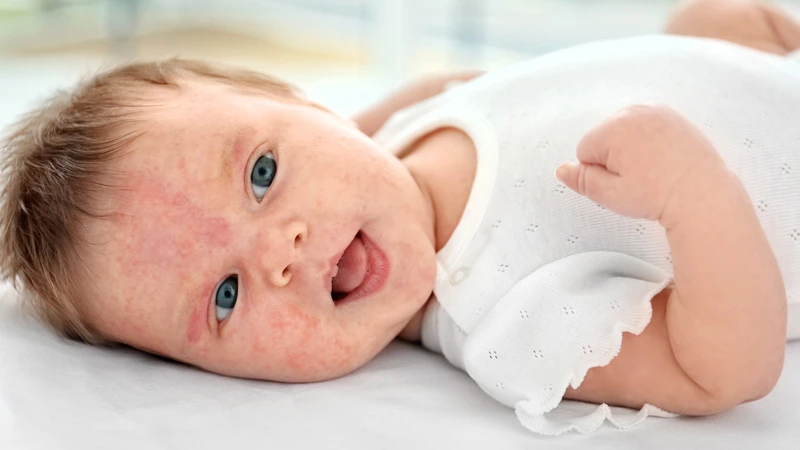 Rôm sảy ở trẻ sơ sinh: Nguyên nhân và cách điều trị 2