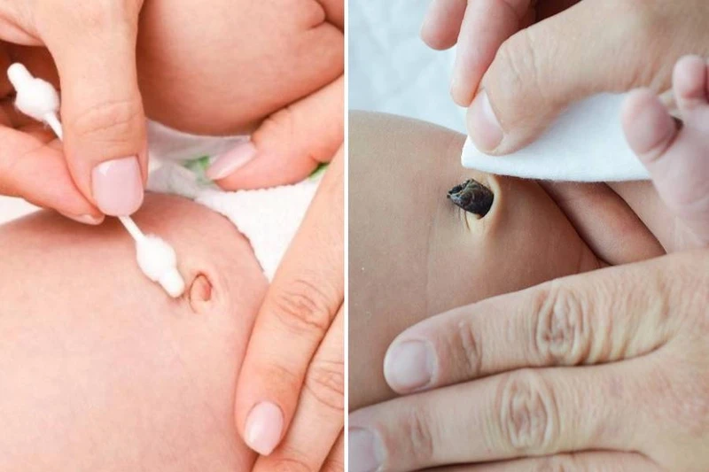 Rốn trẻ sơ sinh bị ướt do đâu? Các biện pháp xử lý 2