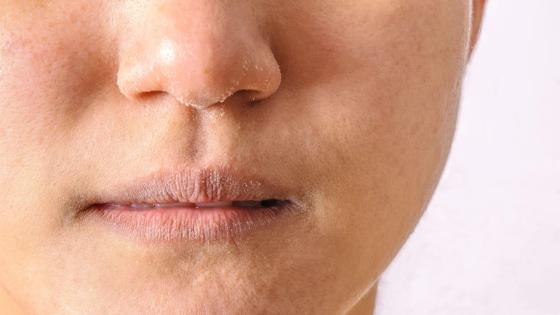 Việc tự pha nước muối không đúng tỉ lệ có thể gây ra tình trạng khô mũi