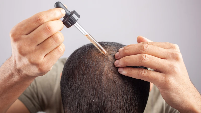 Bôi thoa hỗ trợ mọc tóc có thể được chỉ định
