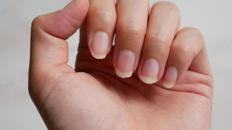 Rụng tóc từng mảng có thể kèm theo các tổn thương móng tay và móng chân