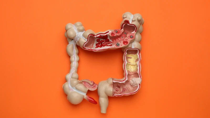 Ruột già là cơ quan dễ bị ảnh hưởng bởi chế độ ăn uống, lối sống và nhiều yếu tố khác