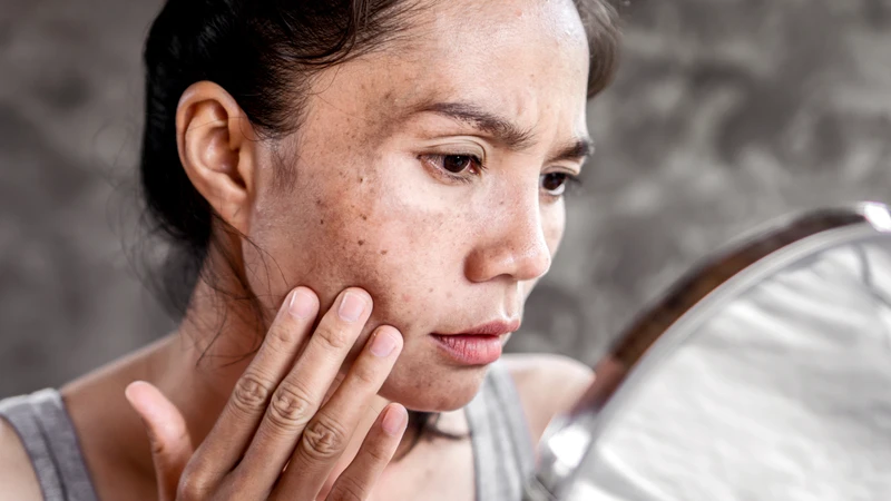 Sạm da là khi có vùng da sẫm màu hơn