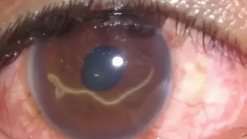 Hiểu đúng khái niệm sán chó ở mắt