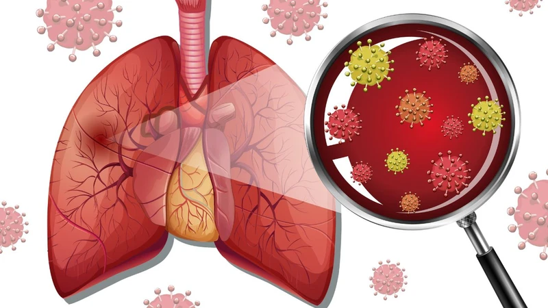 Sẩn gottron là dấu hiệu của bệnh lý tự miễn, do đó người bệnh có nguy cơ gặp biến chứng viêm phổi kẽ