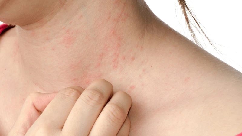 Sẩn ngứa gây triệu chứng ngứa dữ dội cho người mắc phải