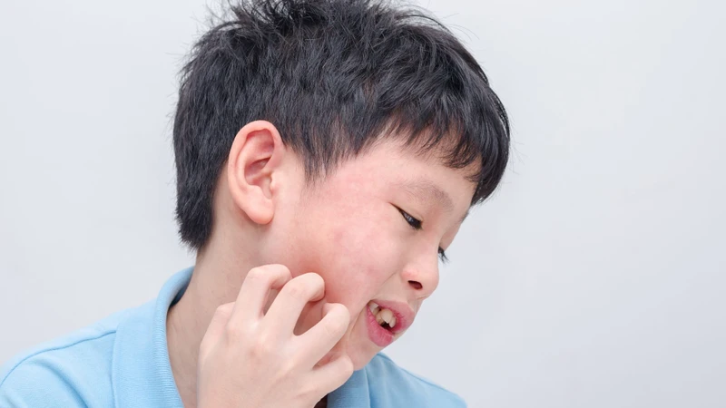 Sẩn ngứa ở trẻ em: Nguyên nhân, dấu hiệu và cách xử lý hiệu quả-2