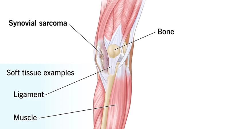 sarcoma-bao-hoat-dich-la-gi-dau-hieu-nguyen-nhan-va-huong-dieu-tri (2).png