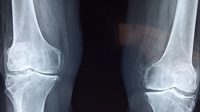 Sarcoma Ewing thường gặp ở xương dài của tay, chân và vùng chậu