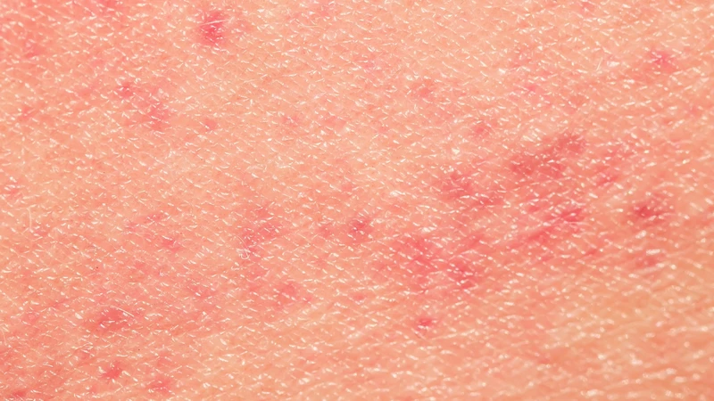 Sarcoma Kaposi có thể biểu hiện bằng các dát hoặc nốt màu đỏ tím trên da