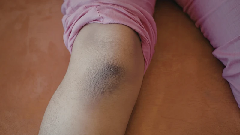 Các tổn thương da màu đỏ tím, vết bầm kéo dài có thể là dấu hiệu cảnh báo sarcoma mạch máu