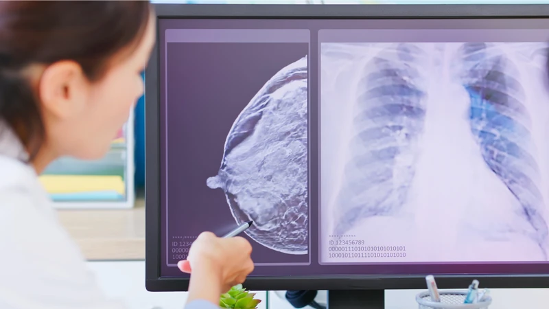 Sarcoma mỡ được chia thành nhiều thể mô bệnh học khác nhau