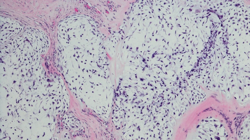 Sarcoma sụn hình thành do sự tăng sinh bất thường của tế bào tạo sụn