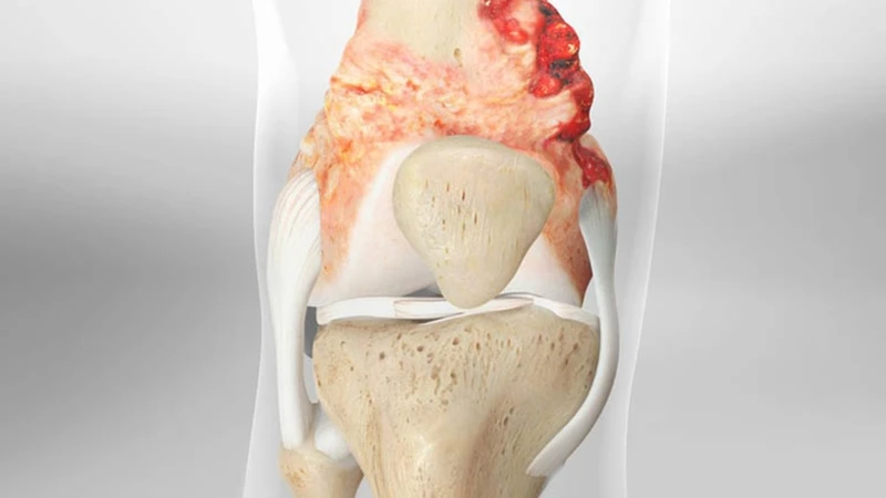 Sarcoma sụn có liên quan đến sự đột biến bất thường trong vật chất di truyền của tế bào