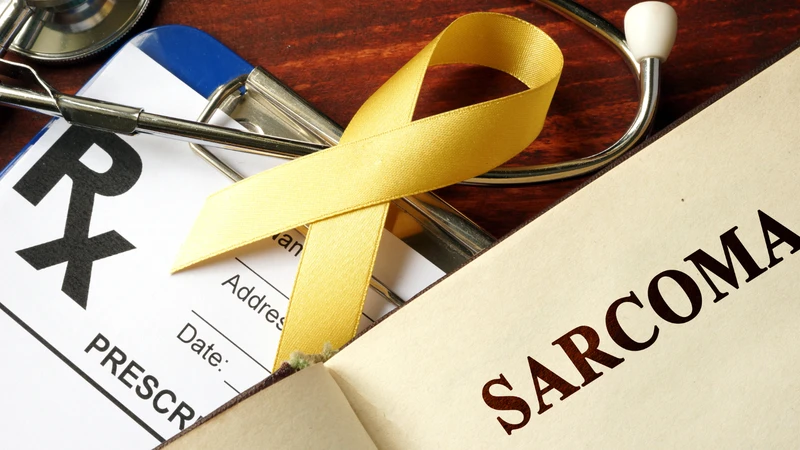 Sarcoma tế bào hình thoi là khối u ác tính hiếm gặp