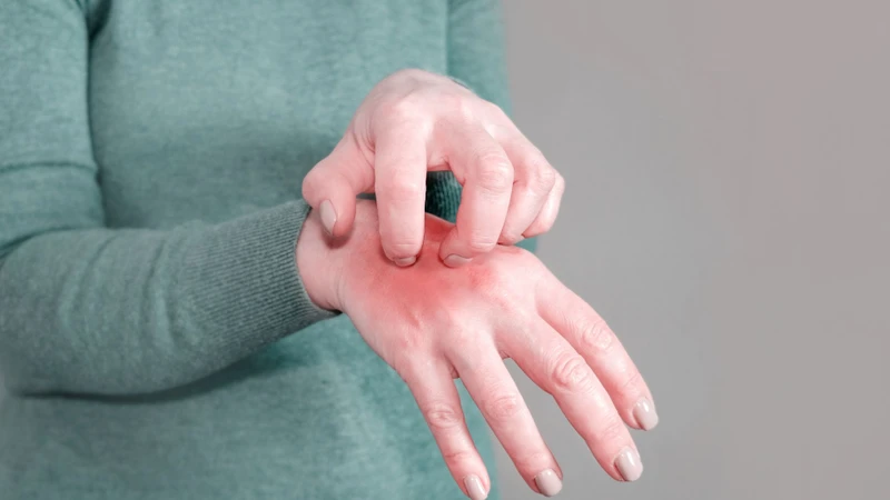 Bệnh ghẻ có thể gây ngứa kéo dài, ảnh hưởng đến giấc ngủ và sinh hoạt