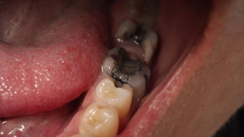 Sâu chân răng do vi khuẩn trong mảng bám răng giải phóng axit làm bào mòn cấu trúc răng