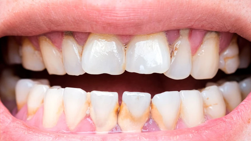 Khi bị sâu, chân răng có thể chuyển sang vàng sẫm, nâu hoặc đen