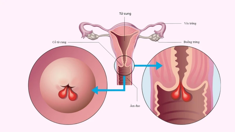 Khi tổn thương gây ảnh hưởng đến sức khỏe hoặc cần loại trừ nguy cơ ác tính, bác sĩ sẽ cân nhắc cắt polyp cổ tử cung