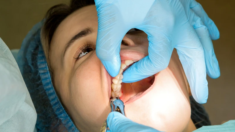 Thời gian lành sau khi nhổ răng khôn thường mất từ 1 đến 2 tuần
