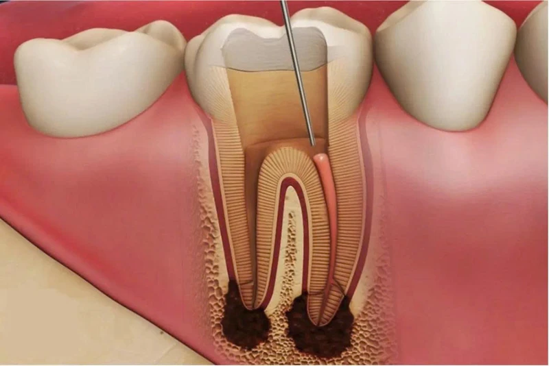 Viêm tủy răng là một trong những thủ phạm gây nên tình trạng đau dai dẳng