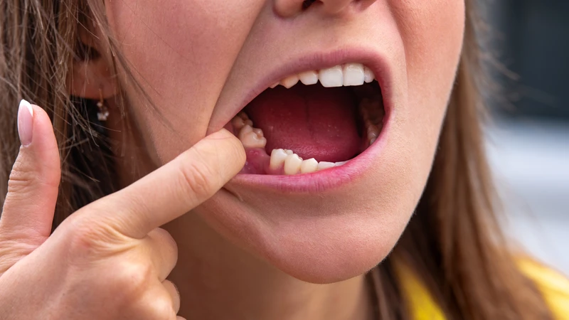 Nếu sâu răng không được xử lý kịp thời, vi khuẩn sẽ gây viêm quanh cuống, lúc này có thể cần điều trị tuỷ hoặc nhổ răng