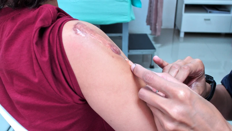 Sẹo lồi là gì? Nguyên nhân và yếu tố nguy cơ gây sẹo lồi 4