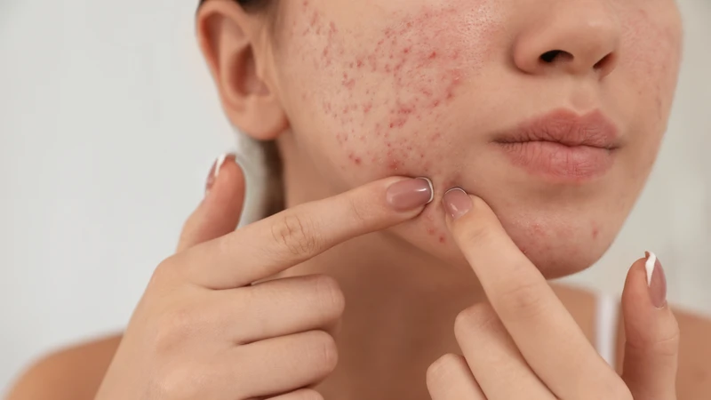 Mụn viêm nặng là một trong những nguyên nhân hàng đầu gây sẹo lõm
