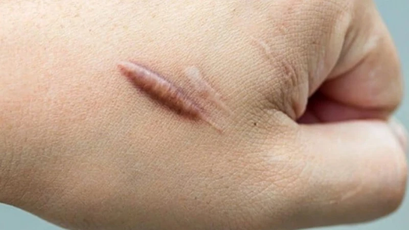 Sẹo phì đại là gì? Sẹo lồi và sẹo phì đại có giống nhau không? 3