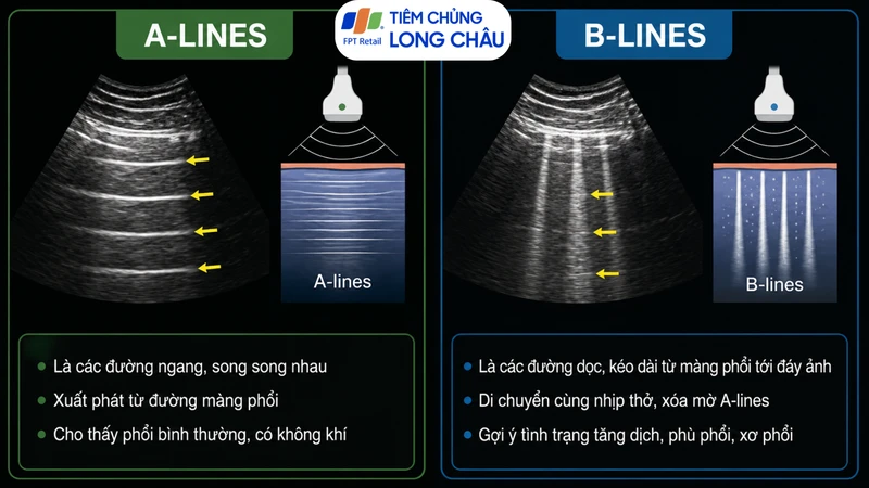 Phân biệt đường A và đường B là kỹ năng cốt lõi trong siêu âm phổi