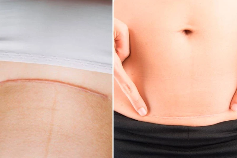 Sinh mổ 1 năm có bầu lại được không? Những rủi ro có thể gặp phải khi mang thai lại quá sớm 2