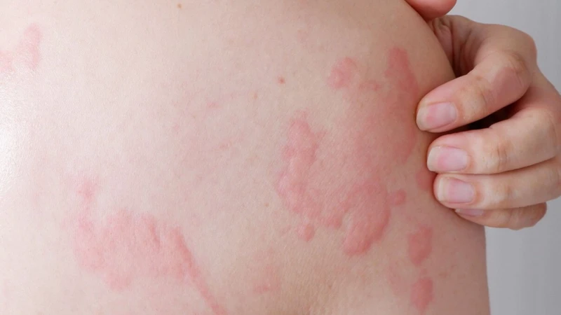 Sốc phản vệ là gì? Nguyên nhân, triệu chứng và cách điều trị 3
