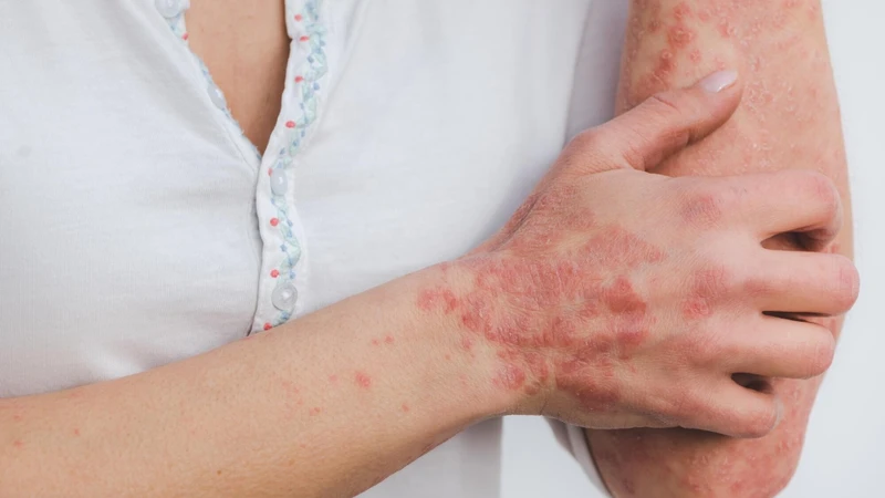 Biểu hiện sốc phản vệ độ 1 khi truyền dịch chỉ khu trú ở da và niêm mạc