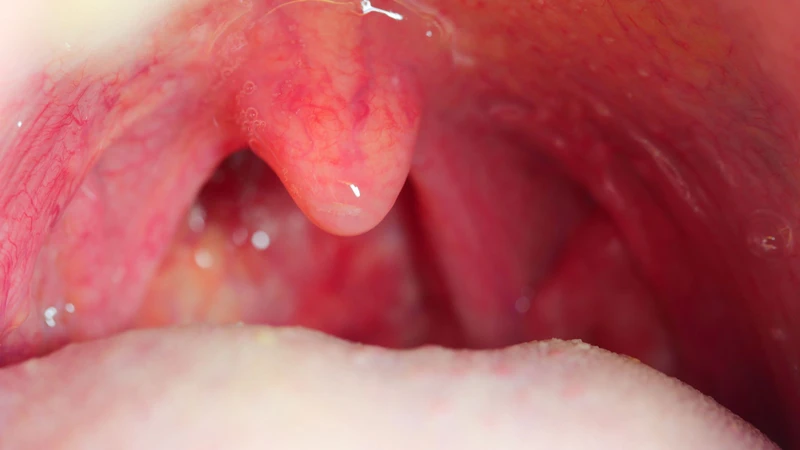 Sỏi amidan có tự khỏi không​? Những thông tin cần biết 2