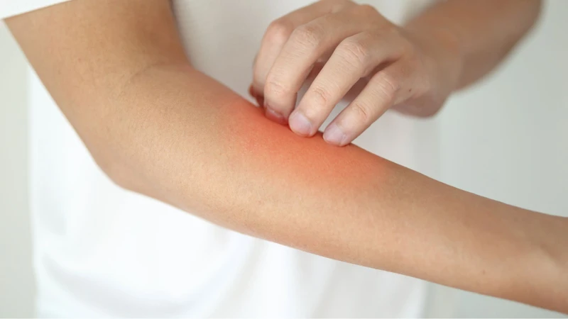 Sỏi mật gây ngứa thường rõ rệt hơn vào buổi tối
