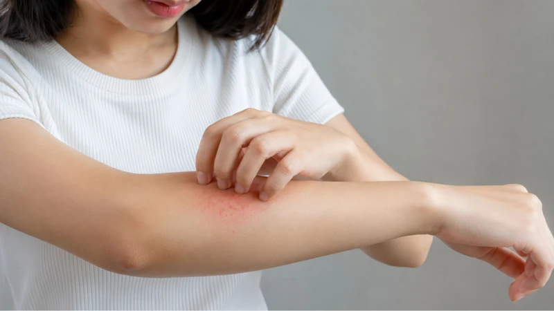 Hạn chế gãi tránh nguy cơ nhiễm trùng da