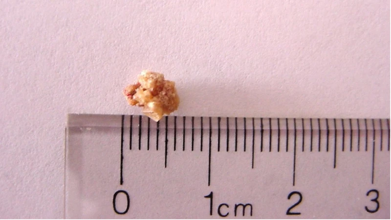 Với sỏi nhỏ dưới 5mm, cơ thể thường có khả năng tự đẩy ra ngoài