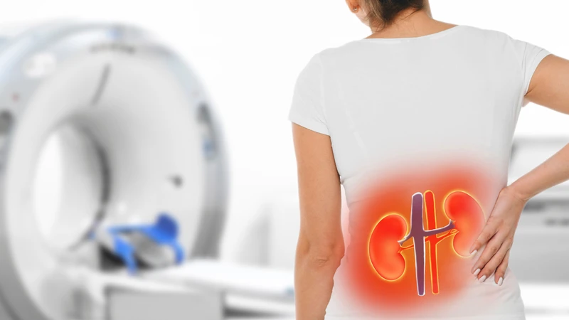 Sỏi lớn gây tắc nghẽn đường tiểu ở cả hai bên thận dễ gây biến chứng suy thận mạn tính