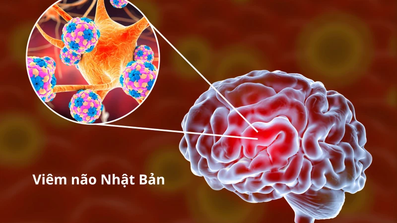 Viêm não Nhật Bản là tình trạng nhiễm trùng cấp gây ra bởi virus viêm não Nhật Bản