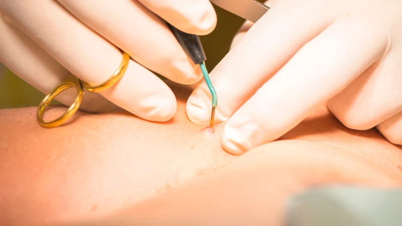Phẫu thuật cắt bỏ là phương pháp đơn giản, trực tiếp