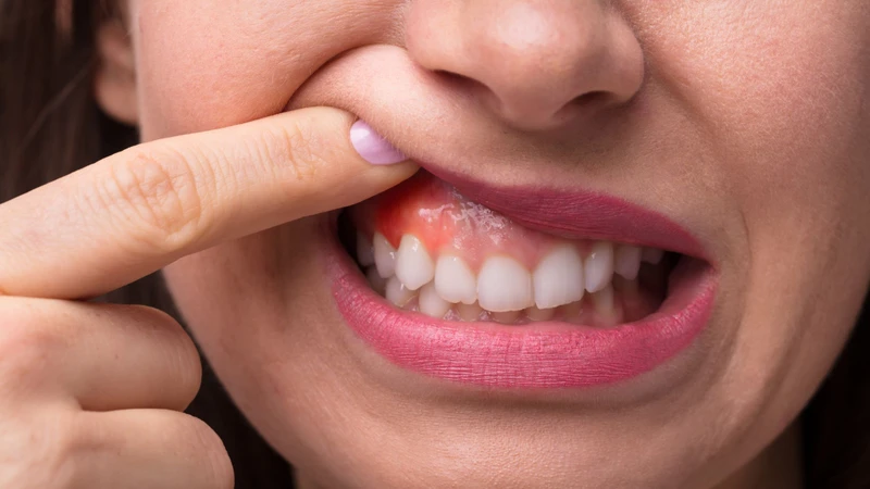 Sưng chân răng là tình trạng mô nướu quanh chân răng bị viêm, sưng đỏ và đau nhức