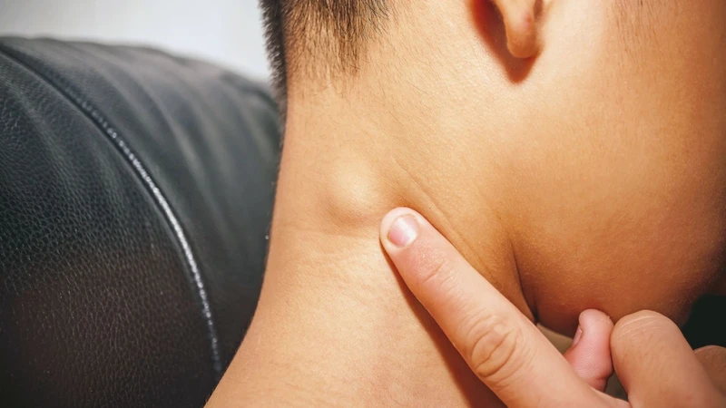 Sưng hạch bạch huyết là gì? Khi nào cần đi khám bác sĩ?