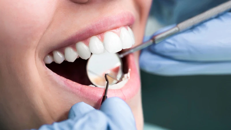 Cạo vôi răng và làm sạch mảng bám là phương pháp đầu tiên giúp loại bỏ mảng bám, từ đó giảm sưng, giảm chảy máu