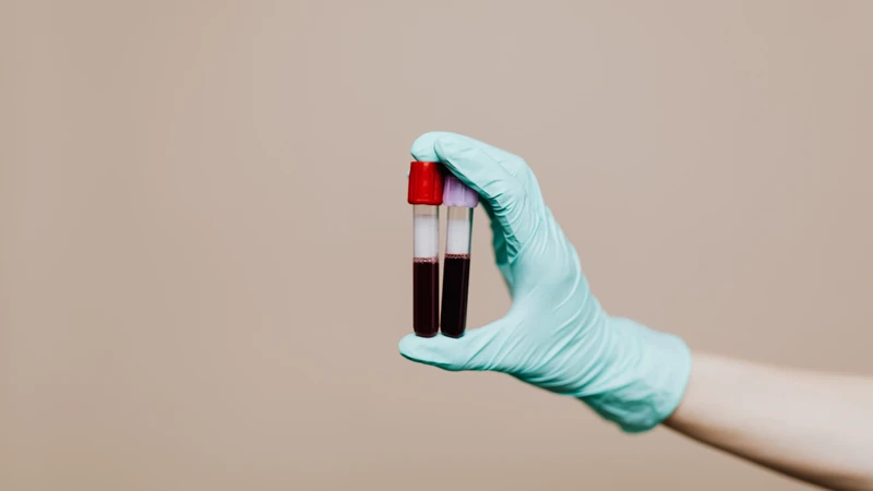 Xét nghiệm máu giúp đánh giá tình trạng suy giảm testosterone