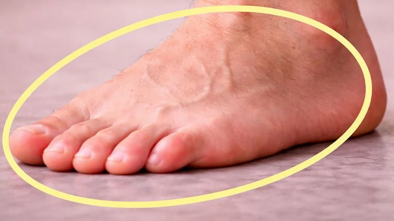Suy van tĩnh mạch chi dưới gây cảm giác nặng chân, sưng phù và nổi gân xanh đặc trưng