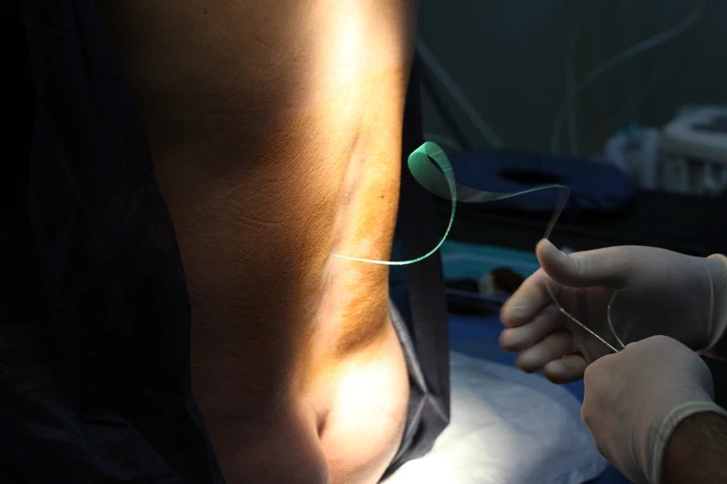 Tác dụng phụ của gây tê ngoài màng cứng sau sinh đối với mẹ bầu là gì? 6