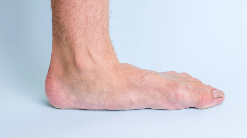 Vòm bàn chân bị sụp là đặc điểm nhận biết rõ rệt nhất